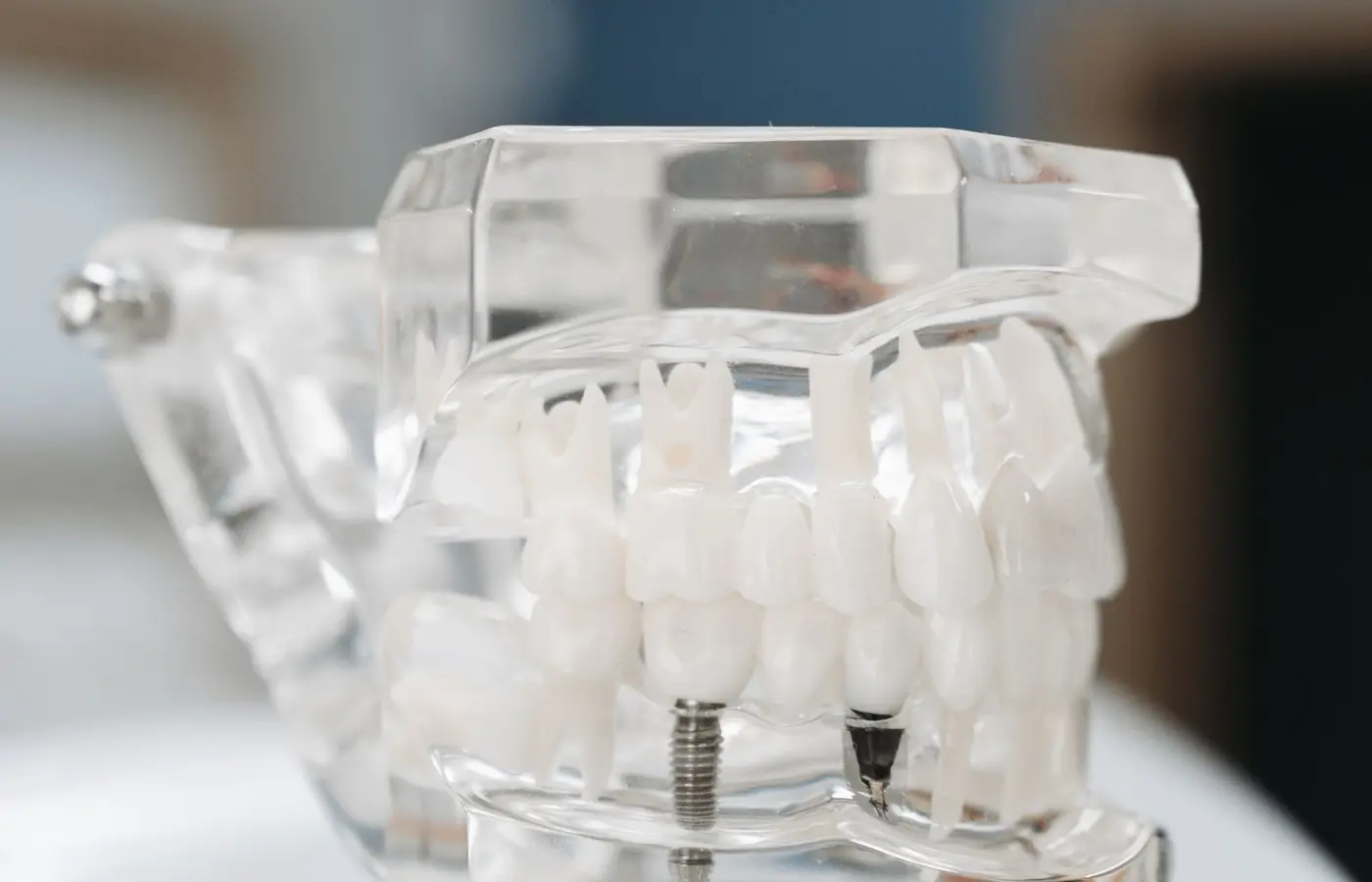 Modelo dental transparente que muestra la posición de un implante de titanio dentro del hueso